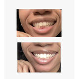 results from after treatment with Brytn Smile teeth whitening kit
