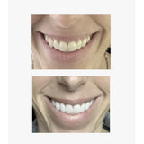 whitening results from the Brytn Smile teeth whitening kit