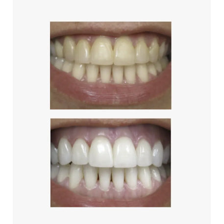 before and after of teeth from Brytn Smile teeth whitening kit